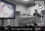 3d lasik