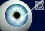 Video introduction of Custom VUE/Wavefront bladeless LASIK