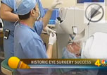 laser cataract