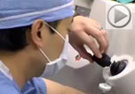 laser cataract