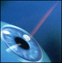 Intralase Surgeon's Photo 2 - Tennessee