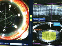 laser cataract