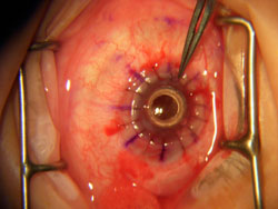 Randy Mathenia's new artificial corneal surgery