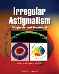 irregular Astigmatism